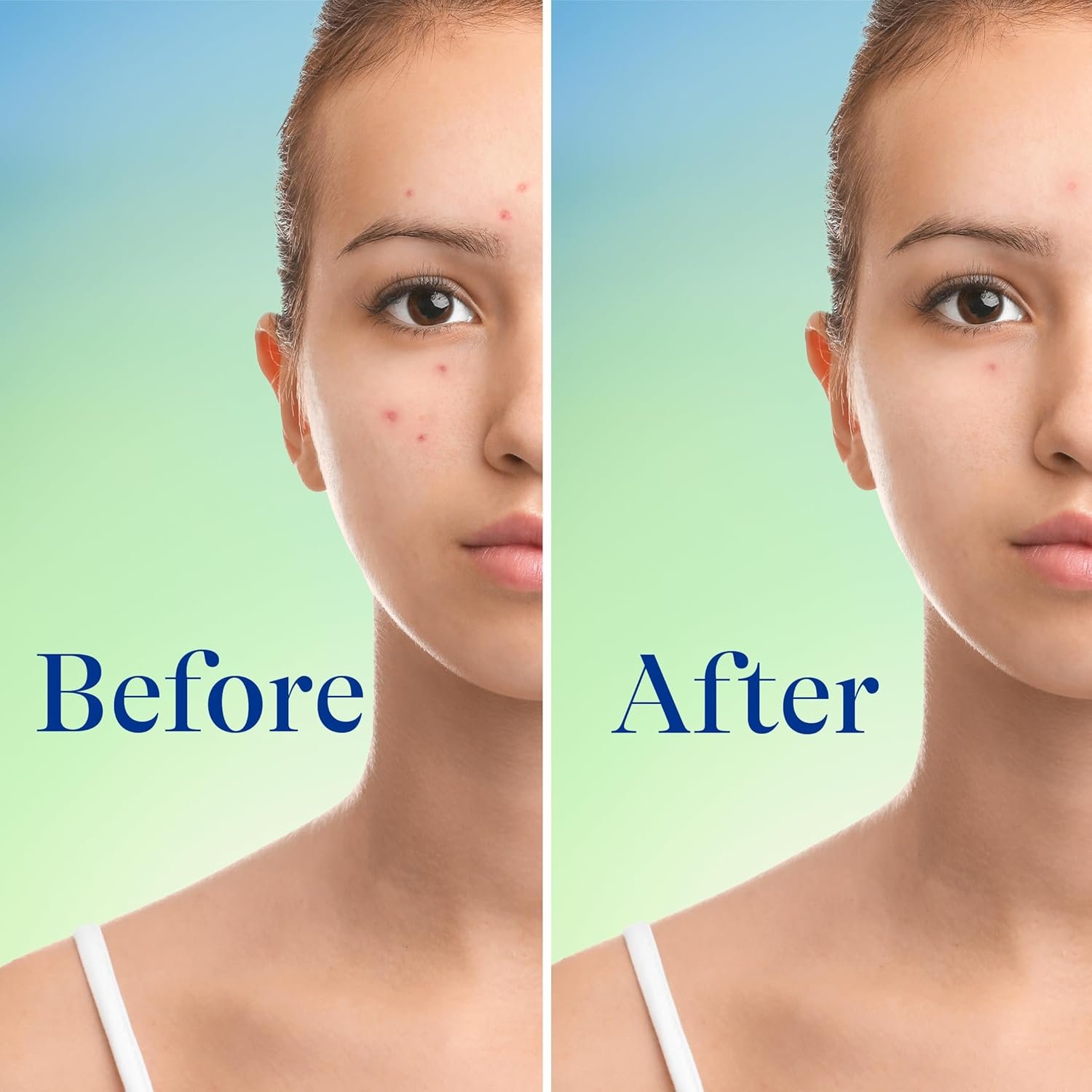 1756234433_Differin-Acne-Face-Wash-with-10-Benzoyl-Peroxide-Maximum-Strength-OTC-Acne-Foaming-Cleanser-Fast-Acting-Acne-Treatment-for-Face-and-Body-5-oz.jpg
