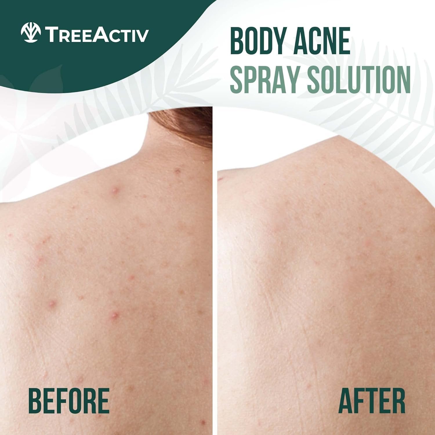 Salicylic-Acid-Back-Body-Acne-Spray-Back-Acne-Solution-For-Women-And-Men-Acne-Body-Spray-with-Tea-Tree-Oil-Fast-Drying-Back-Acne-Spray-Fine-Mist-Back-Acne-Treatment-Spray-4-fl-oz-2-pack.jpg