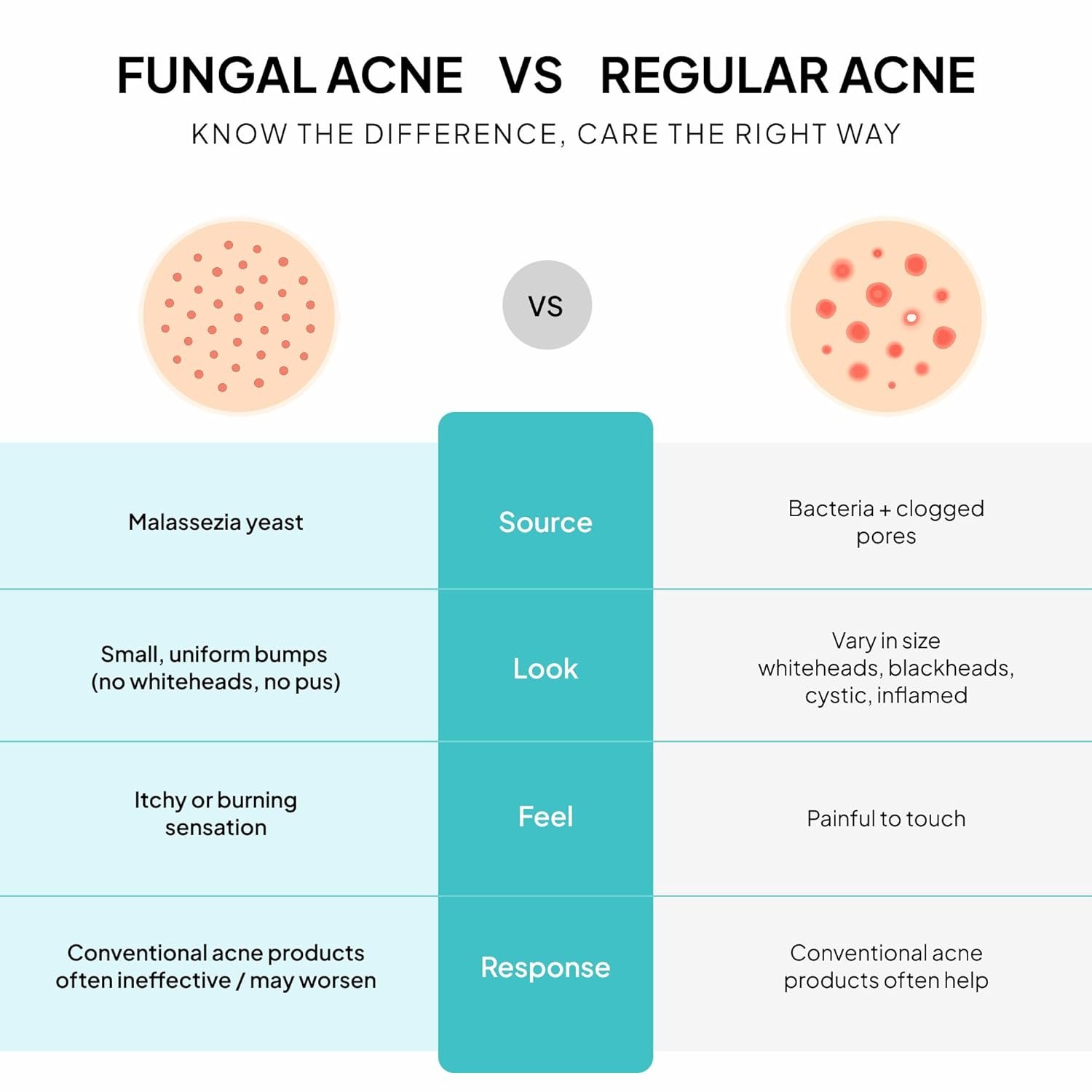 1761612052_Fungal-Acne-Treatment-Lotion-Effective-Face-Body-Pimple-Cream-for-Bumps-Clusters-Itch-Redness-–-Fungal-Prone-Skin-Acne-Treatment-Moisturizer-for-Teens-Adults-with-Natural-Actives.jpg