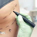 Stop dithering on Brazilian butt lift crackdown, say MPs